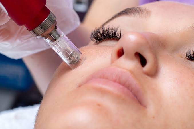 Microneedling skin treatment