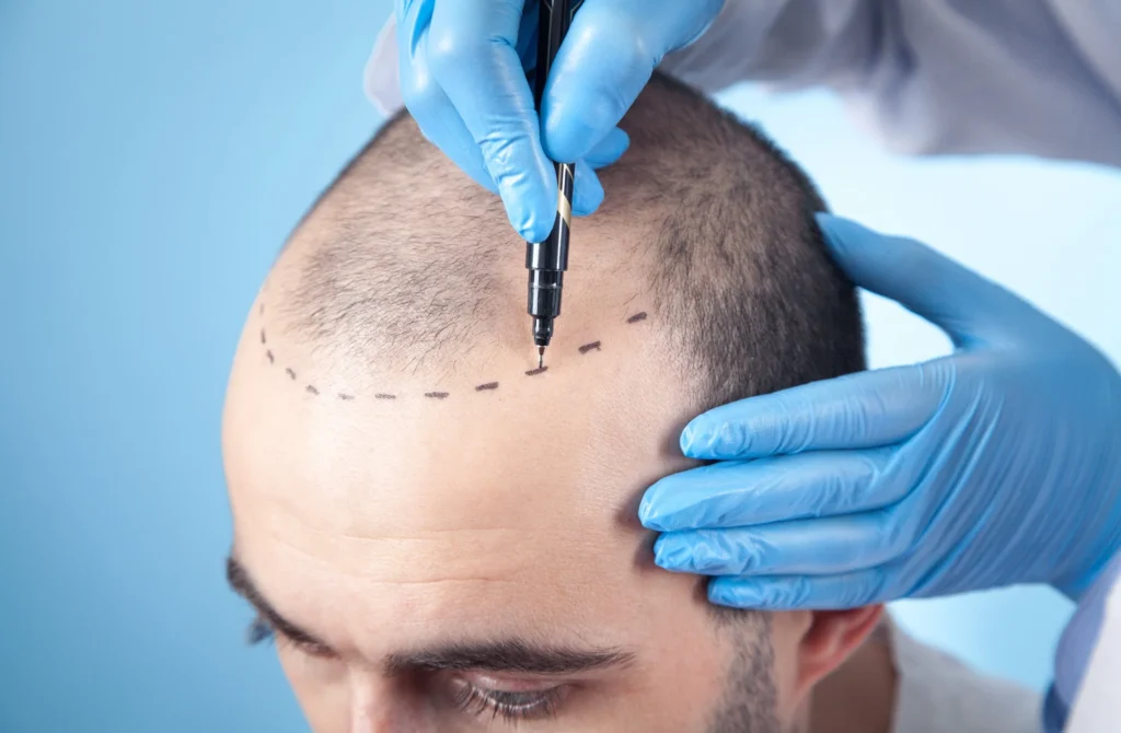 Drawing the outline for a new hairline on a patient's head before surgery.