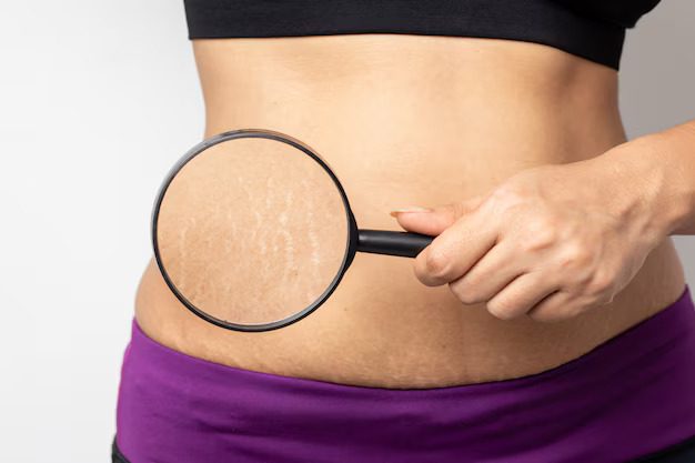 Stretch Mark Removal in Bangalore