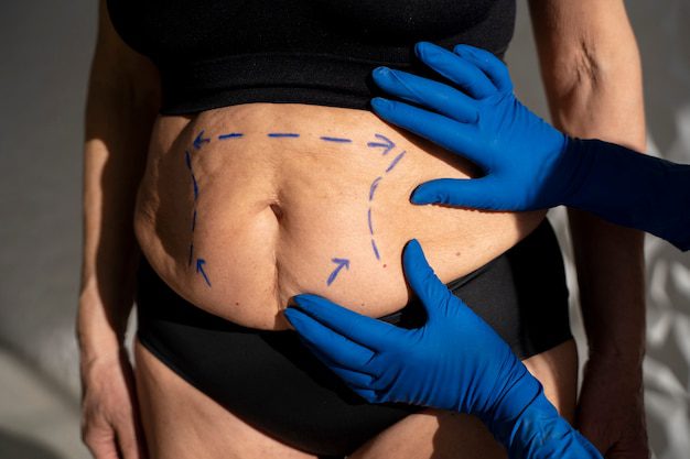 Tummy Tuck in Bangalore