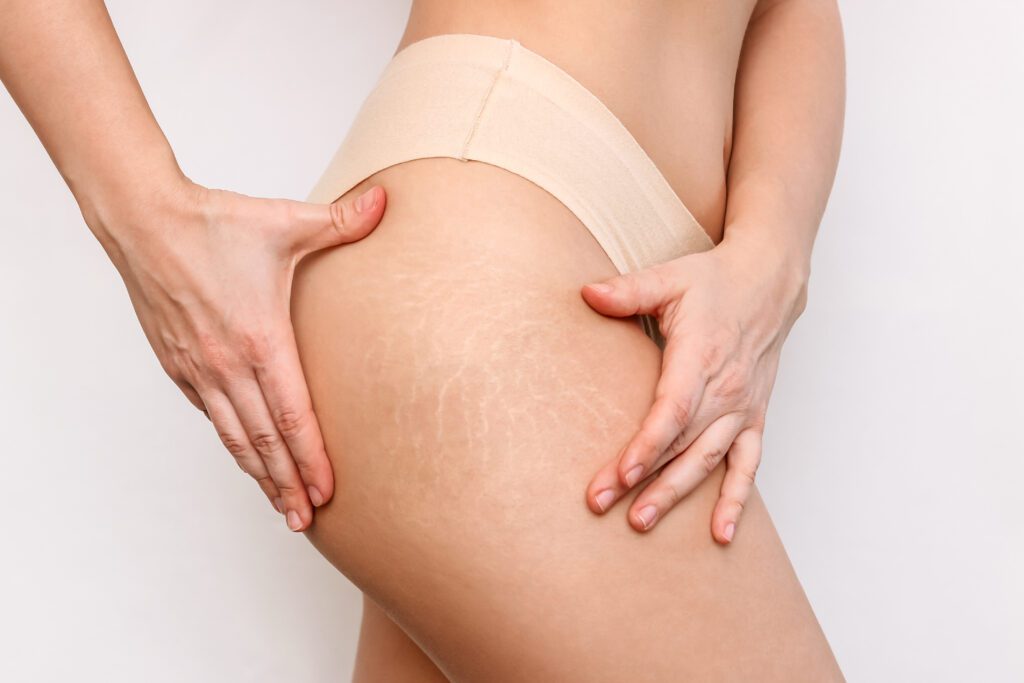 Stretch Marks Removal
