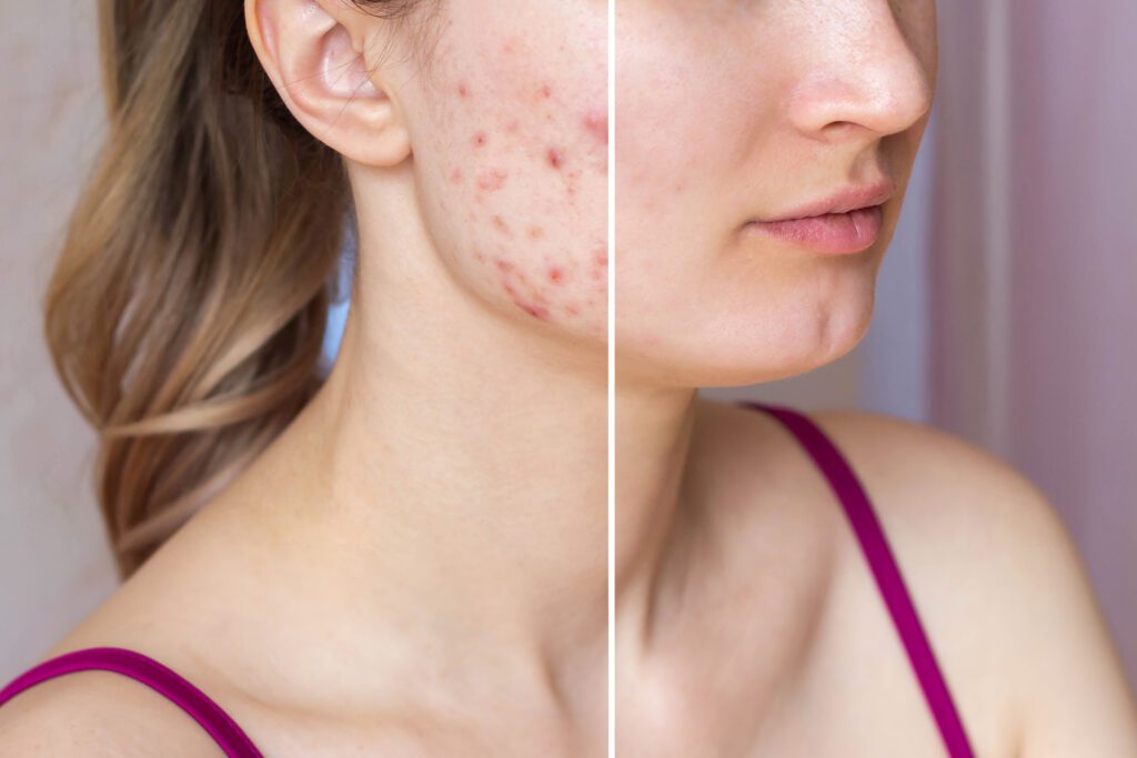 Acne and Pimples Treatment