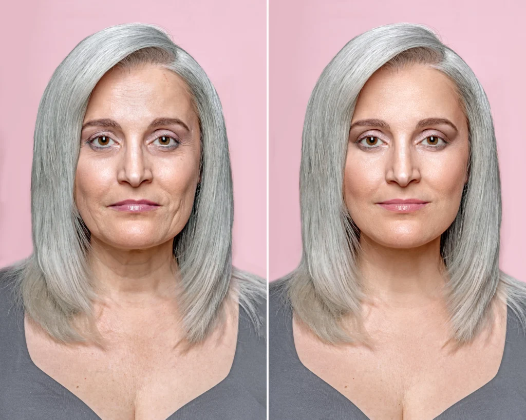 Face Tightening