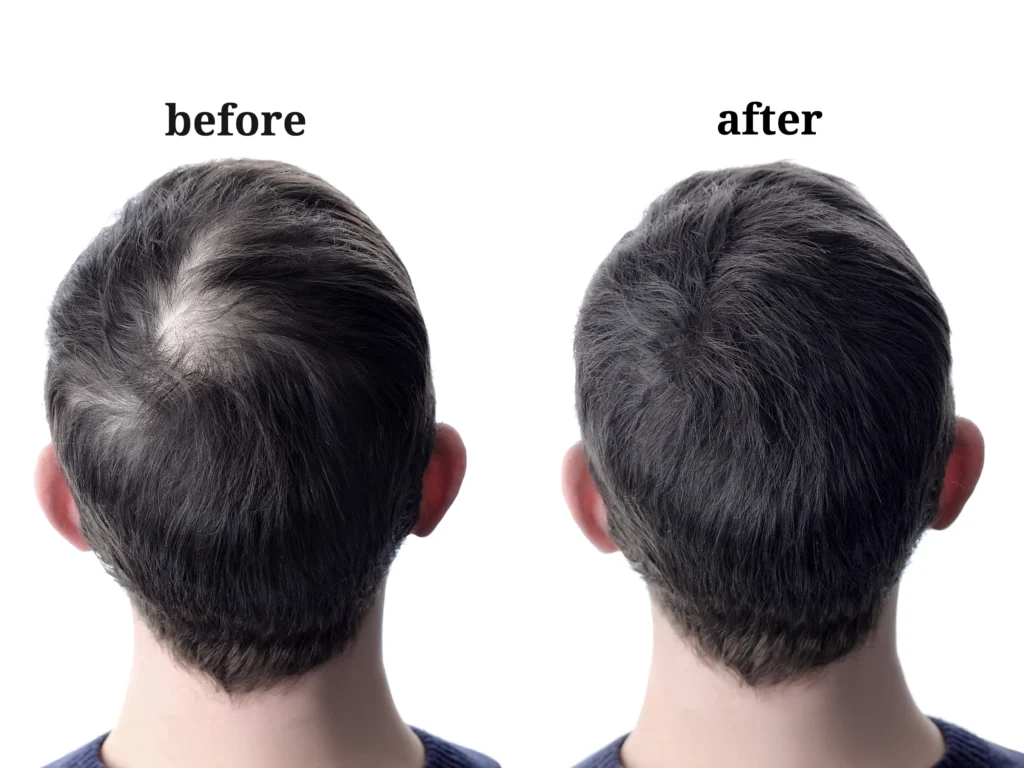 Hair Loss Treatment in Bangalore